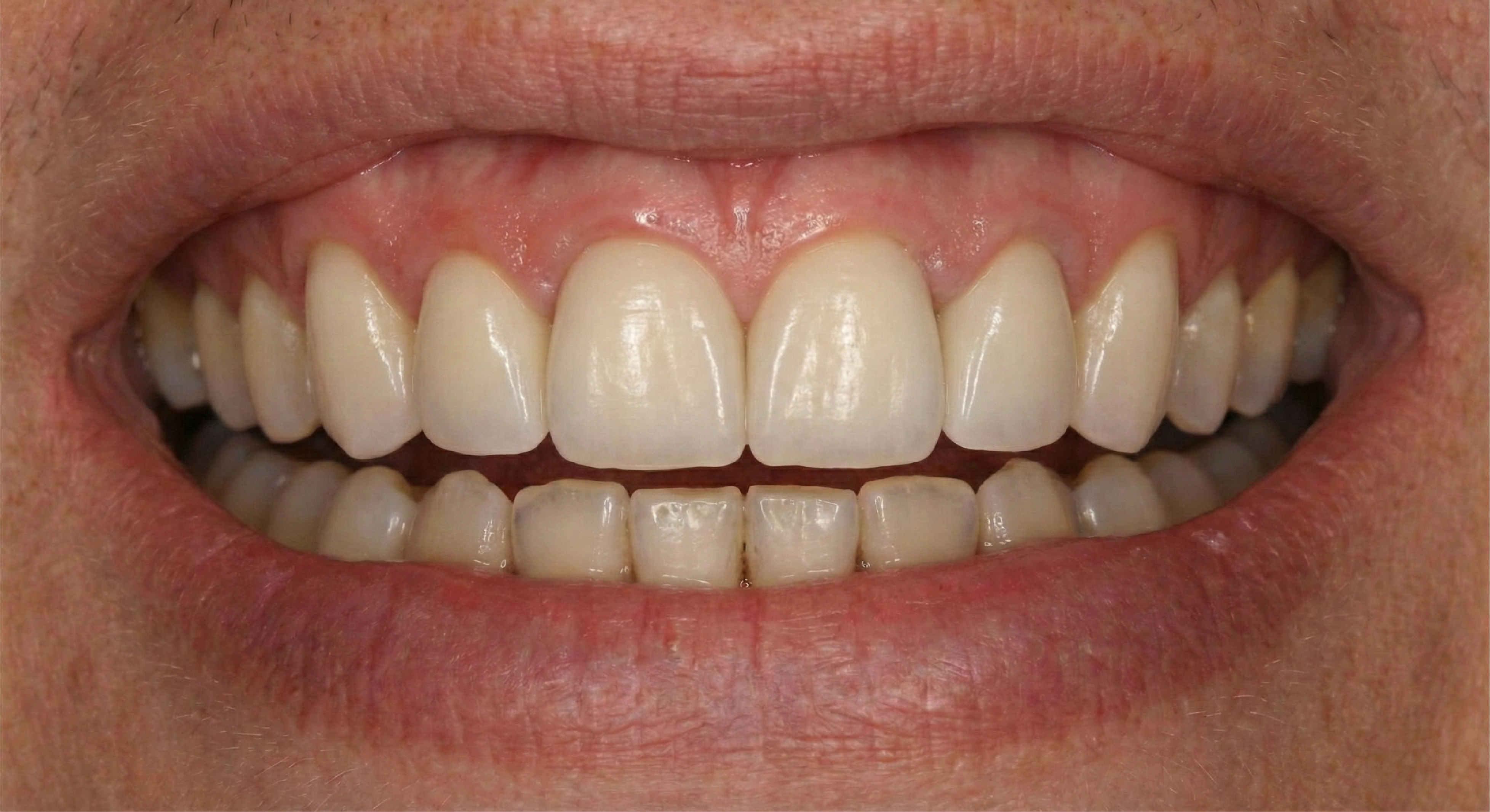 After — Zirconia Crowns